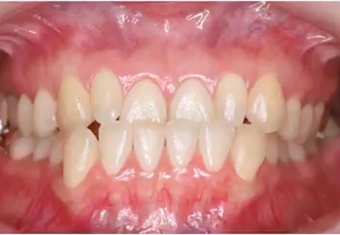 Các Giai Đoạn Và Quy Trình Niềng Răng Móm Bạn Cần Biết